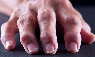 Cûdahiya di navbera arthritis ji arthrosis de çi ye