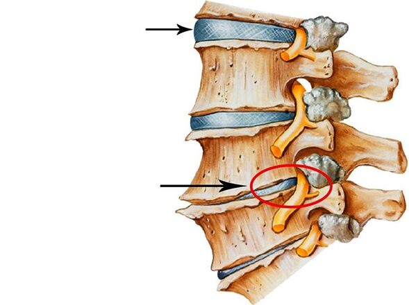 Insêwazên di dîskên intervertebral de