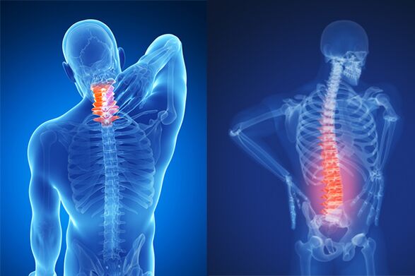 Osteochondrosis ya stûyê malzarok û lumbar