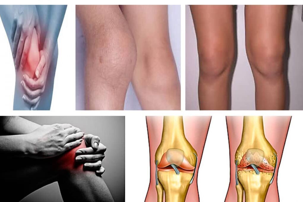 arthrosis ew çi ye