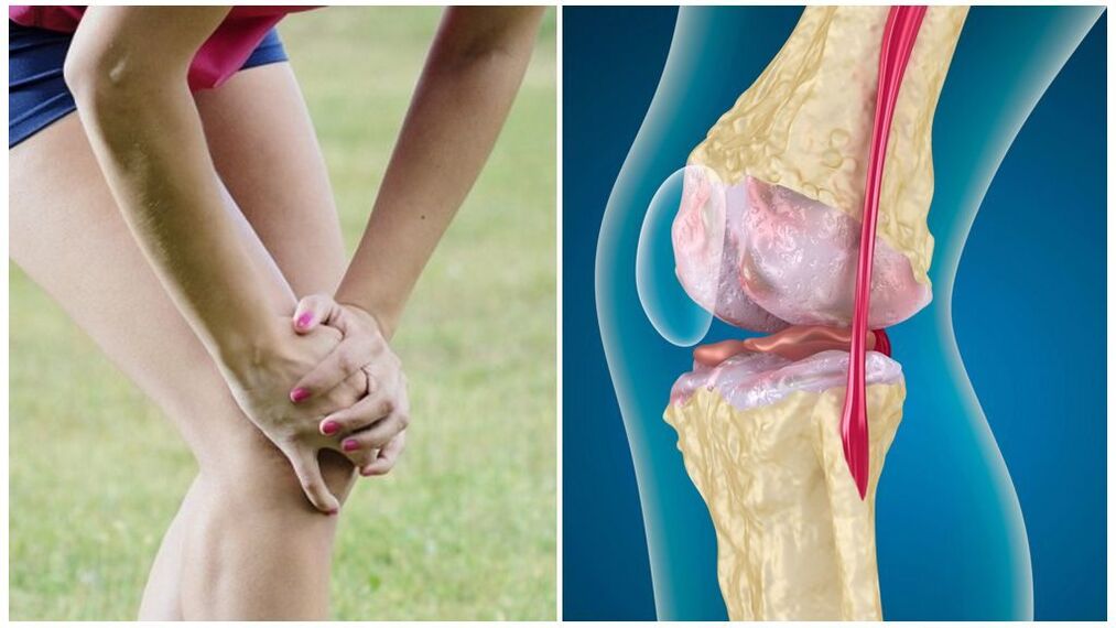 nîşanên arthrosis