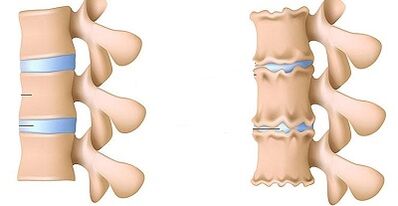 Meriv çawa hebûna osteochondrosis ya lumbar nas dike