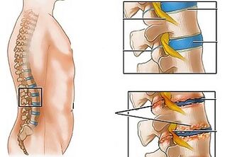 Sedemên osteochondrosis of lumbar